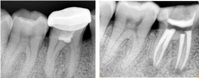 根管治疗前后对比图片